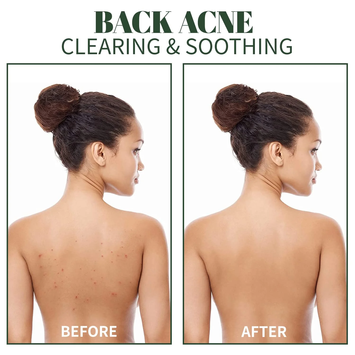 MELIKE Calming Relief Body Mist – Face, Butt, Back Acne, Chest Treatment Spray 150 ml - Image 8